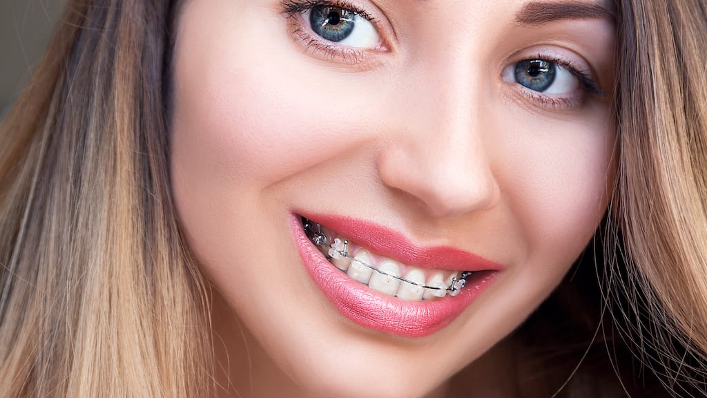 A woman with blue eyes and long hair smiles, revealing metal braces on her teeth, though she considers switching to clear aligners for a more subtle look.