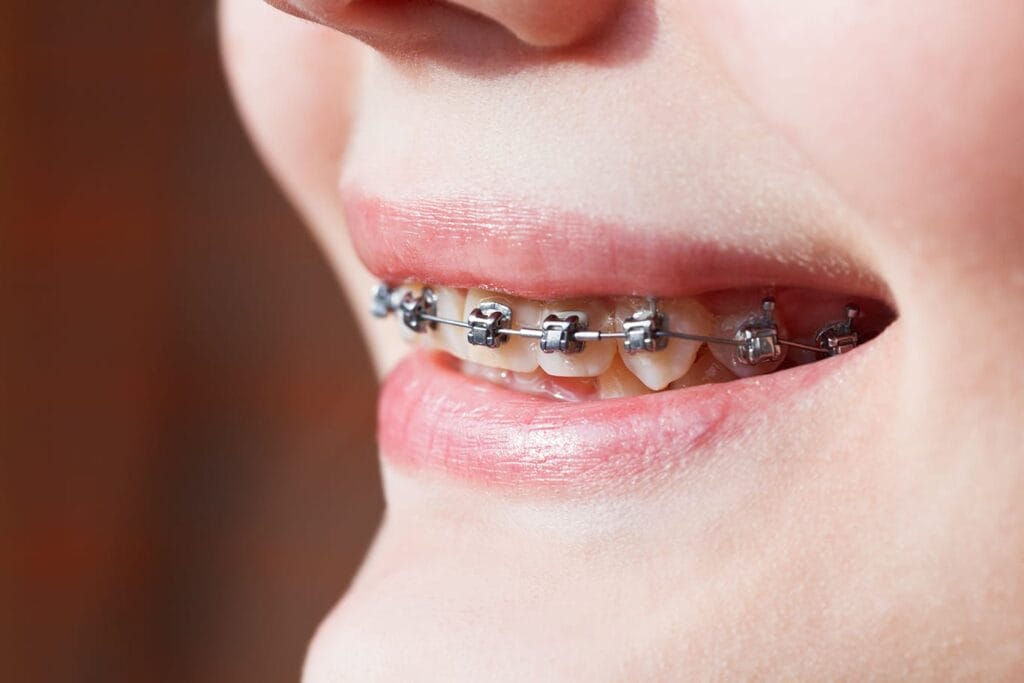 Close up of a person smiling, with self-ligating metal braces.