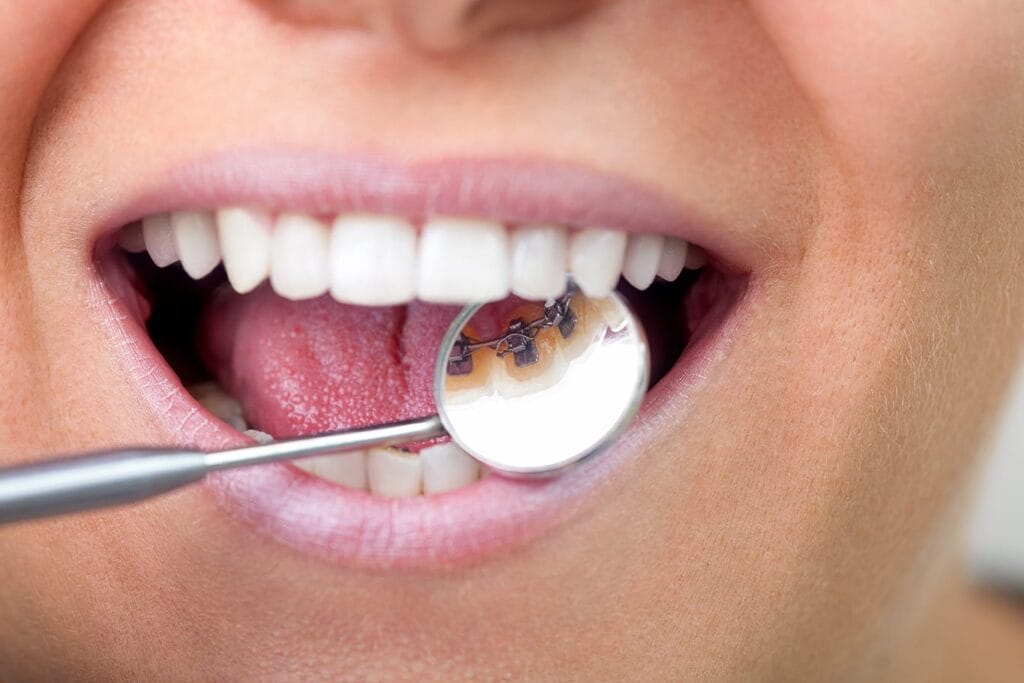 Close up of a mouth with lingual braces.