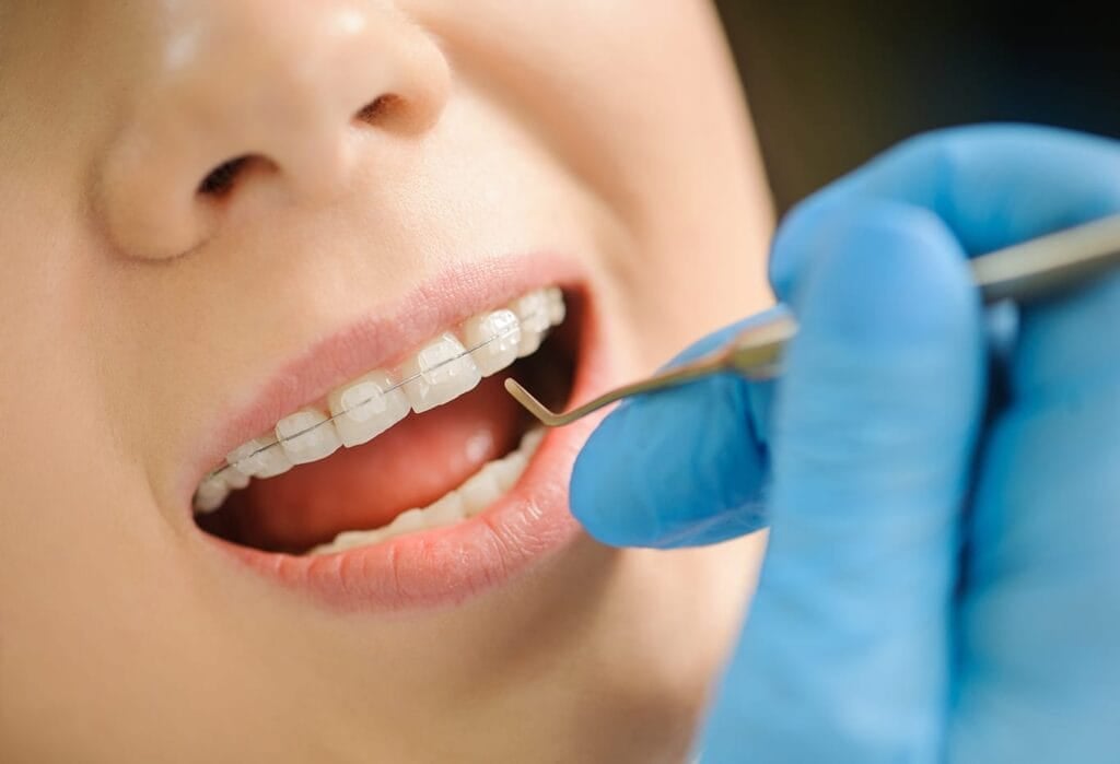 Close-up of a woman wearing ceramic braces.