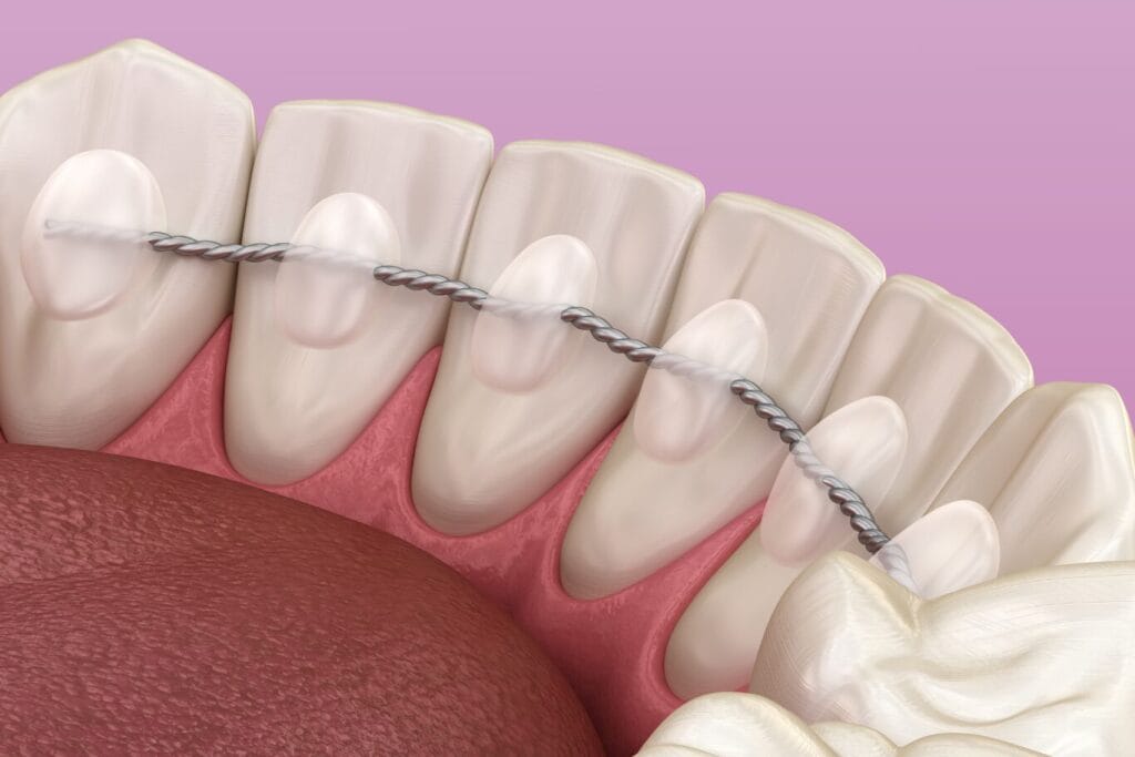 A close-up illustration of lower teeth with a fixed dental retainer wire attached to the inner surfaces, showing details on how to clean retainers, set against a pink background.