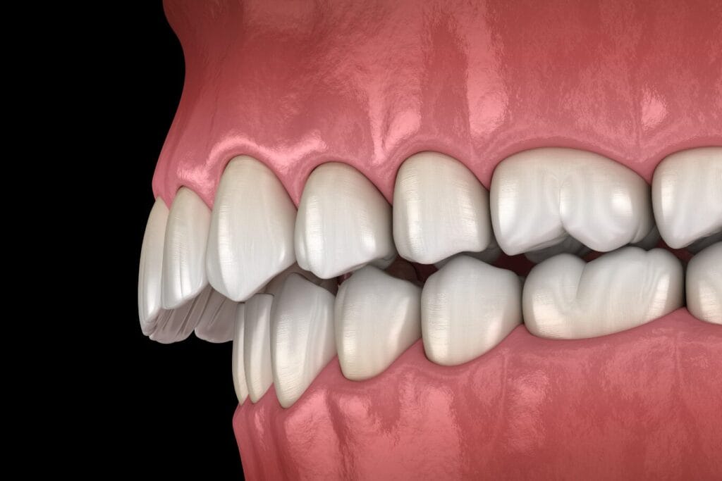 can invisalign fix overbite: A digital illustration showing an overbite, with the upper front teeth extending noticeably over the lower teeth