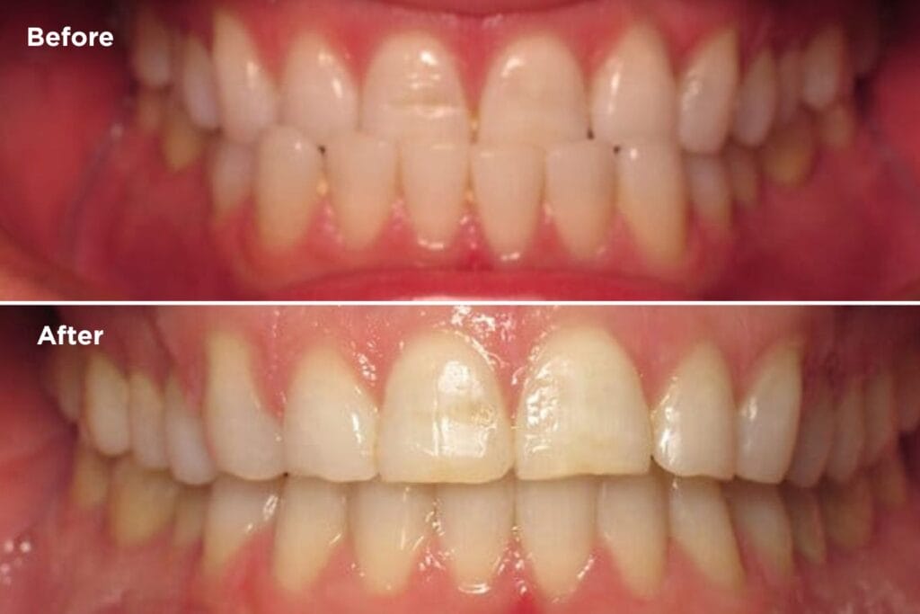 Before-and-after photos showing underbite correction with Invisalign treatment