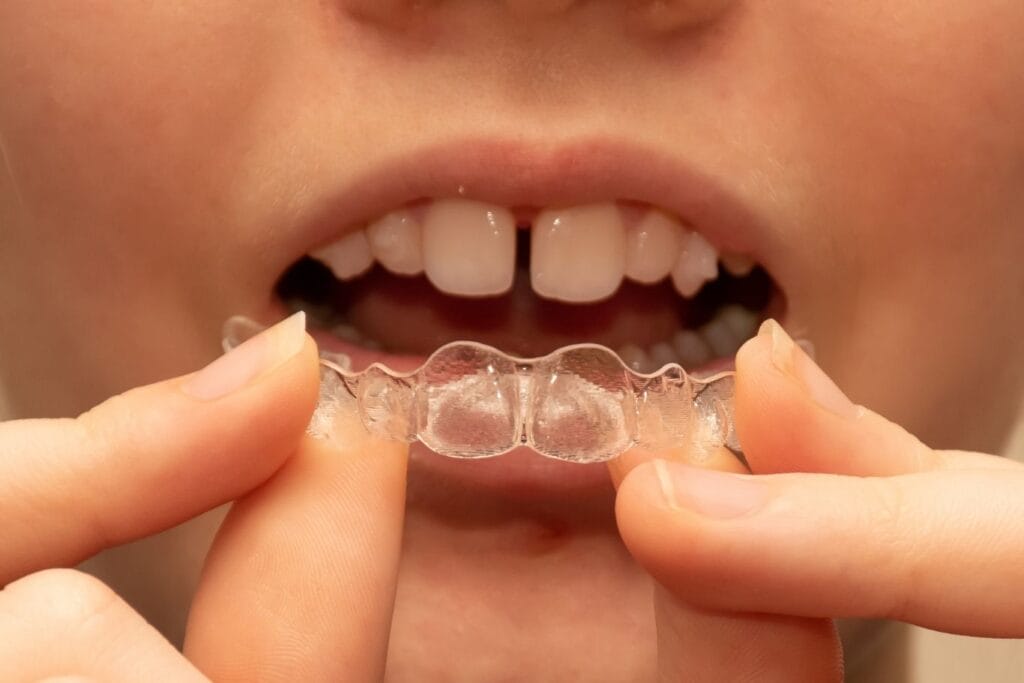 Close-up of a person holding a clear dental aligner in front of their mouth, showing a visible gap between the front teeth