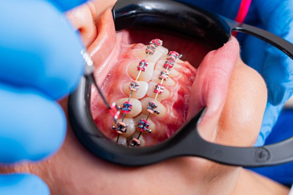 Can you get braces with missing teeth? A close-up of a person's mouth with braces during a dental checkup, showing a dental tool and cheek retractors in use.