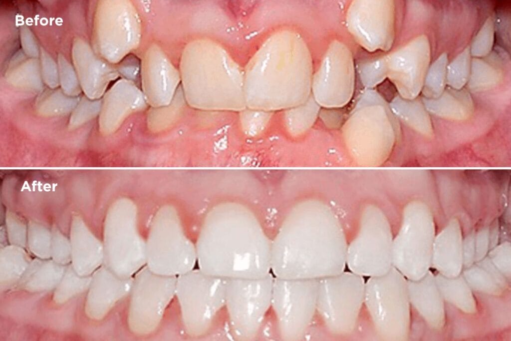 Before-and-after orthodontic treatment images showing crowded, misaligned teeth before treatment and straight, evenly aligned teeth after treatment