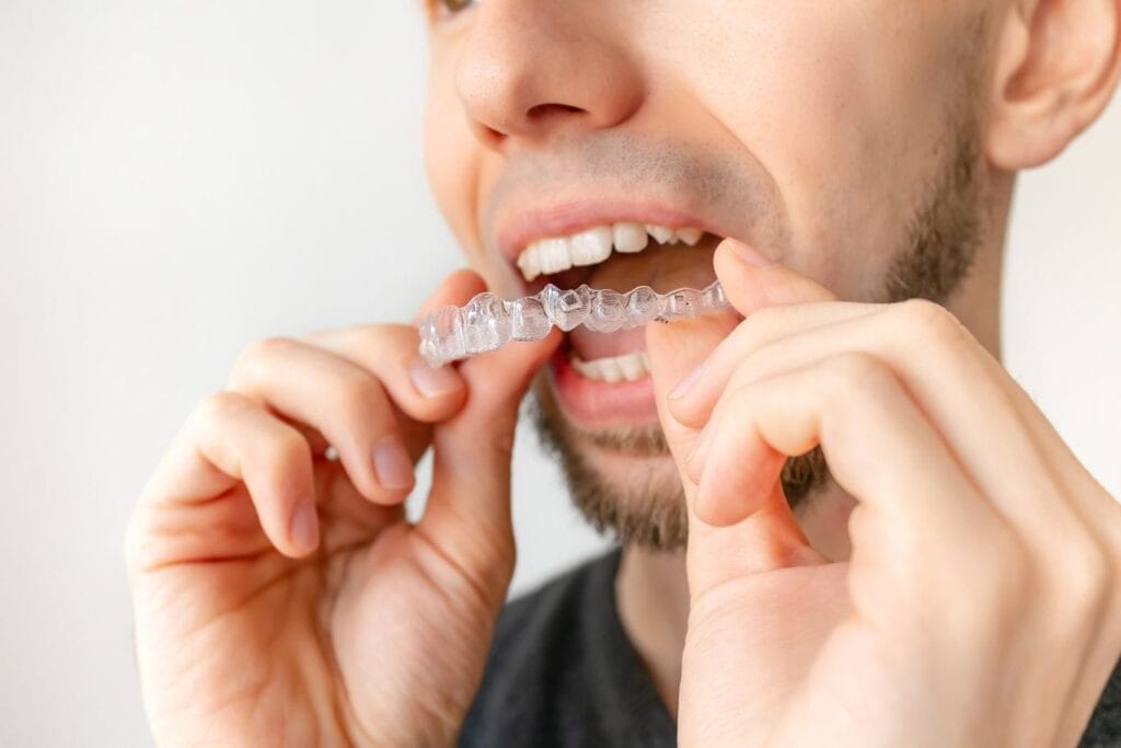 A person holds and inserts a clear dental aligner onto their upper teeth, demonstrating how treatments like Invisalign can fix open bite issues.