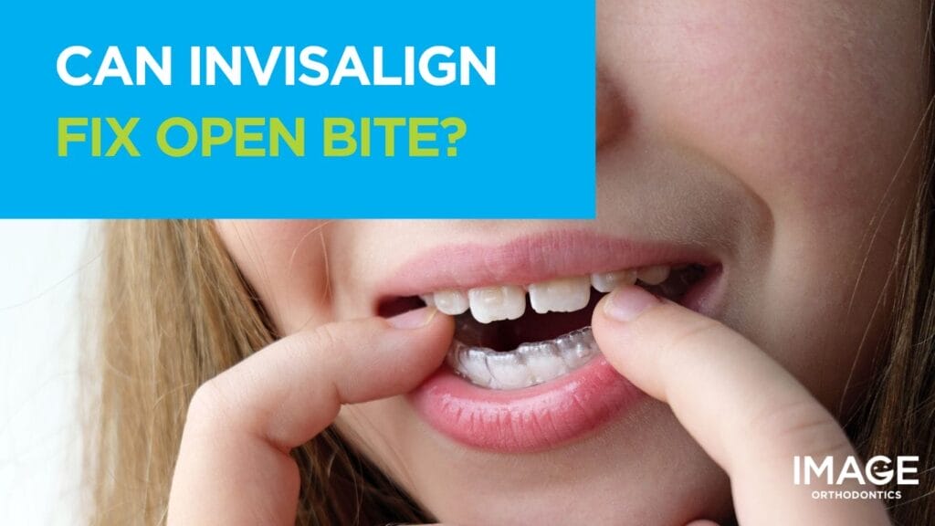 Close-up of a young woman with an open bite placing a clear Invisalign aligner onto their teeth.